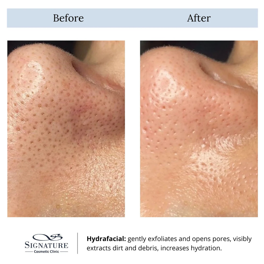 hydrafacial treatment-hydrafacial before and after-hydrafacial markham