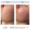 hydrafacial before and after-hydrafacial toronto-deep cleansing