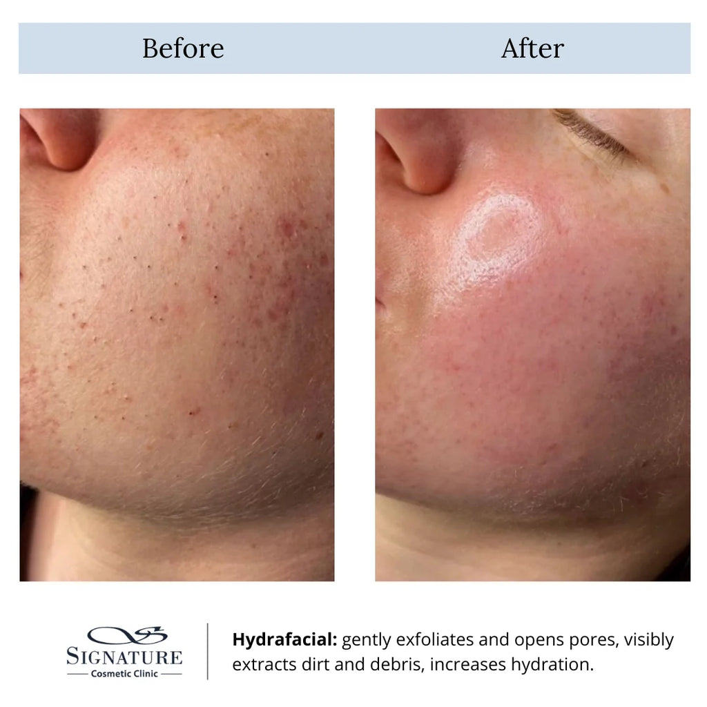 hydrafacial before and after-hydrafacial toronto-deep cleansing