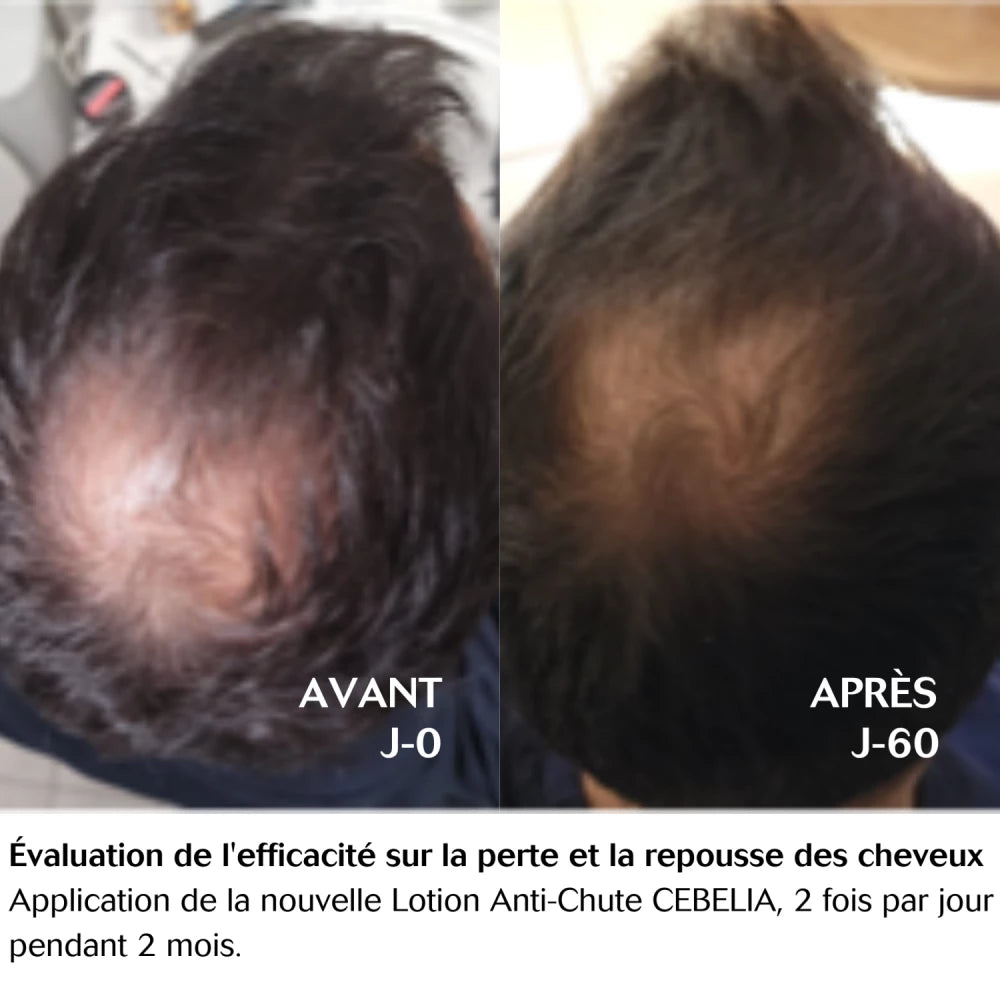 Cebelia Anti-Hair Loss Lotion-before and after result
