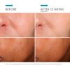 skinceuticals phloretin cf before and after-SkinCeuticals Vitamin C Serum