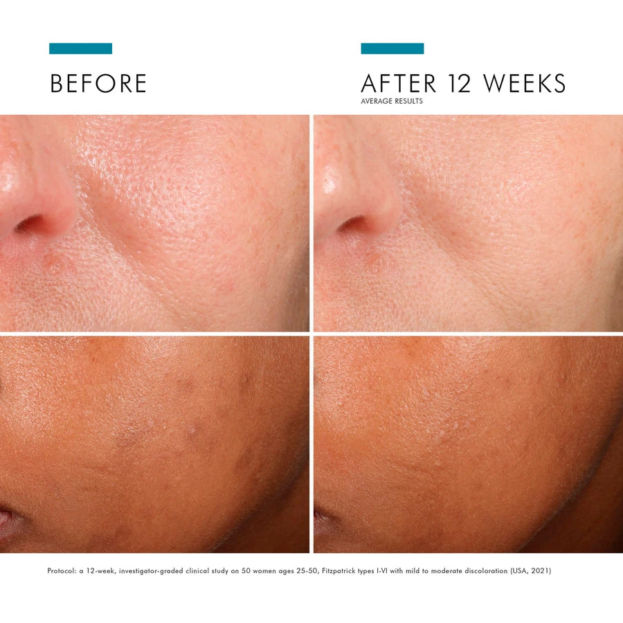 skinceuticals phloretin cf before and after-SkinCeuticals Vitamin C Serum