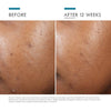skinceuticals phyto a+ brightening treatment-before and after