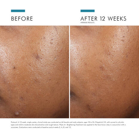 skinceuticals phyto a+ brightening treatment-before and after