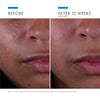 skinceuticals silymarin cf-skinceuticals vitamin c-before and after