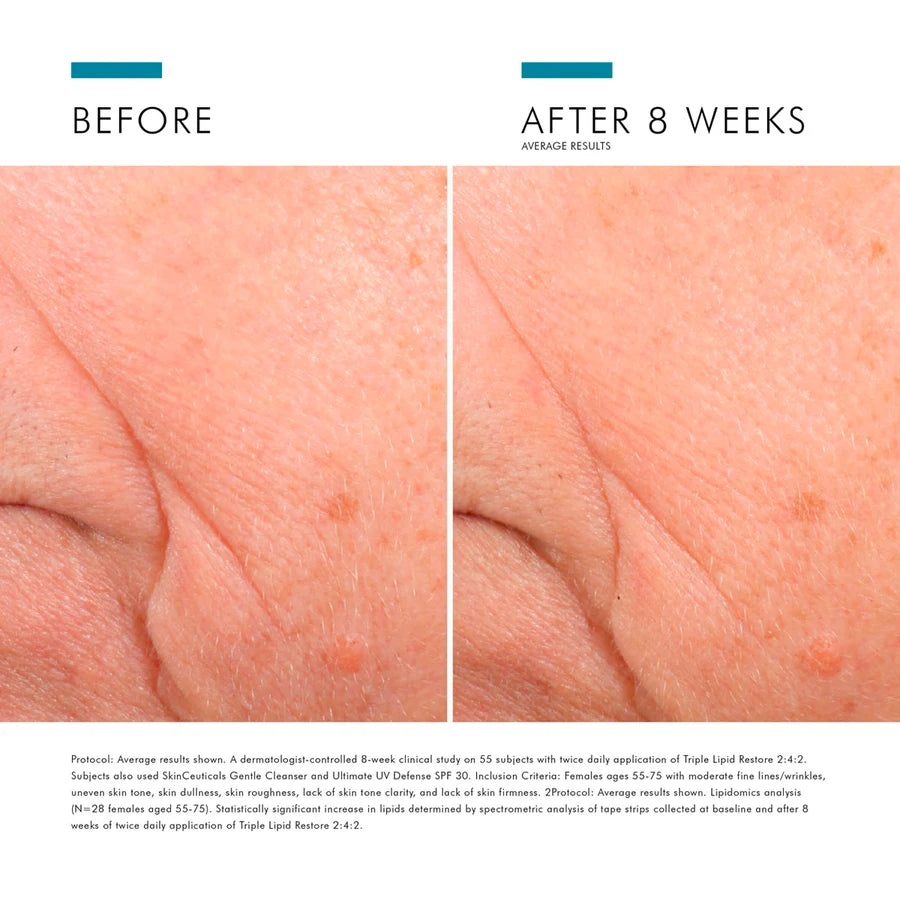 skinceuticals triple lipid restore-skinceuticals moisturizer-before and after