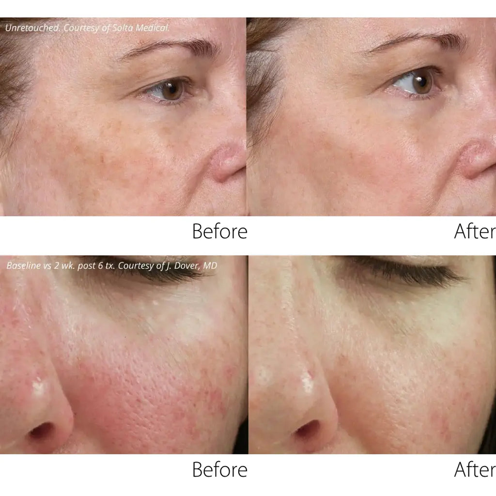 clear and brilliant before and after-clear and brilliant laser toronto