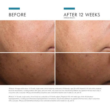 skinceuticals discoloration defense-before and after